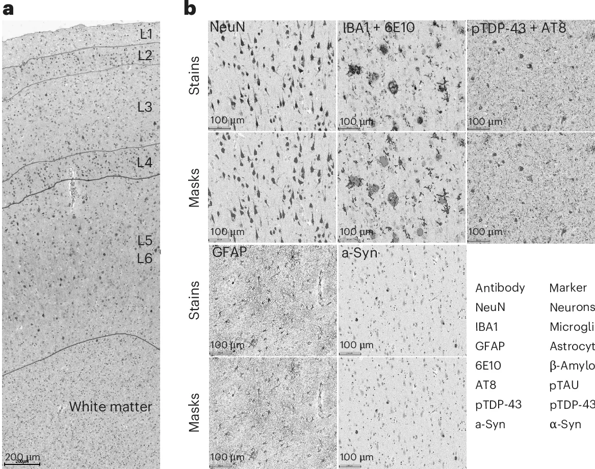 Immunohistochemistry of a cortical column from the SEA-AD cohort, with stains for neurons, microglia, amyloid, tau, astrocytes and alpha-synuclein